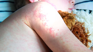 Brote de Sarampión en el Condado de Gaines, Texas: Una Advertencia sobre las Bajas Tasas de Vacunación